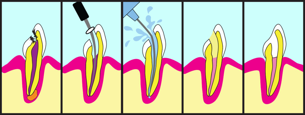 Root Canal Treatment procedure