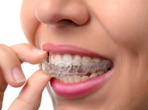 Invisalign Treatment Dental Braces Clear Aligners Straighter teeth