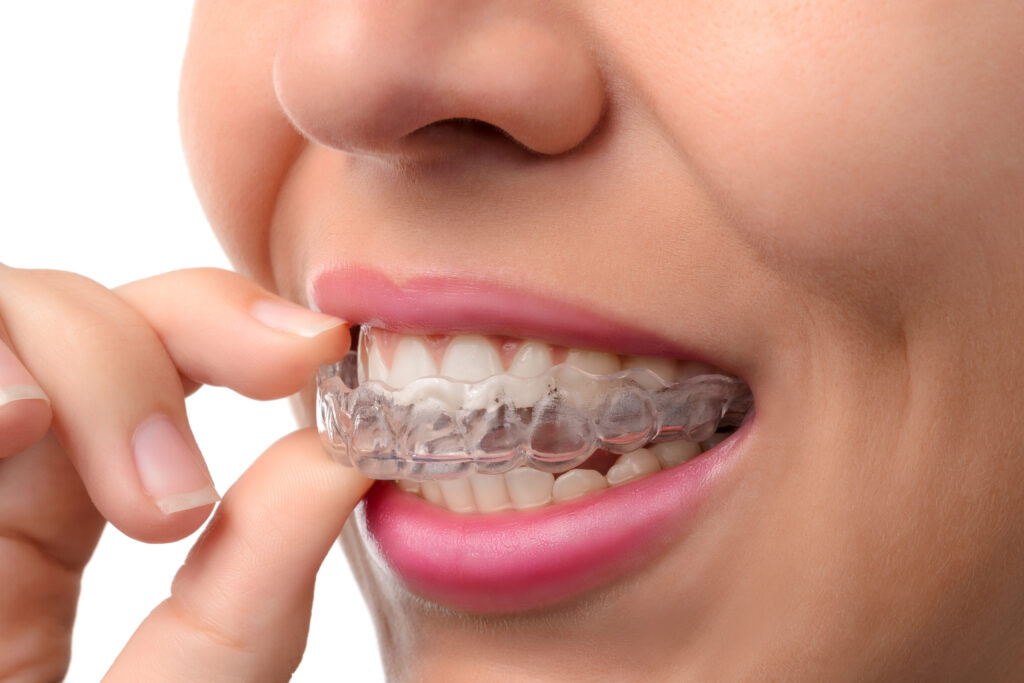 Invisalign Treatment Dental Braces Clear Aligners Straighter teeth Patient services Healthy Smiles Dental Hartford