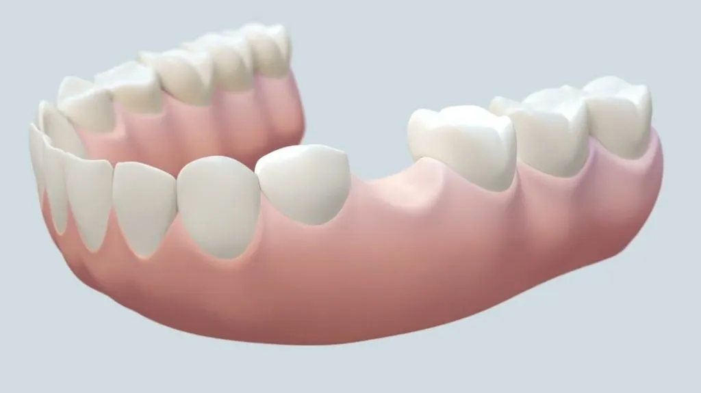 Dental Bridge Initial