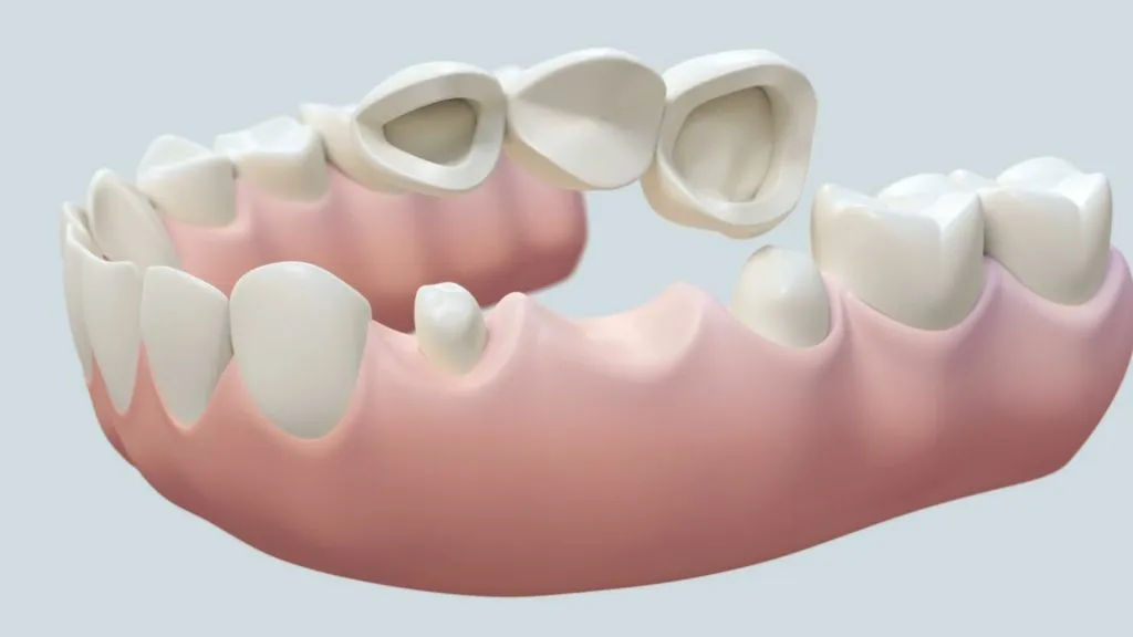 Bridge cementation