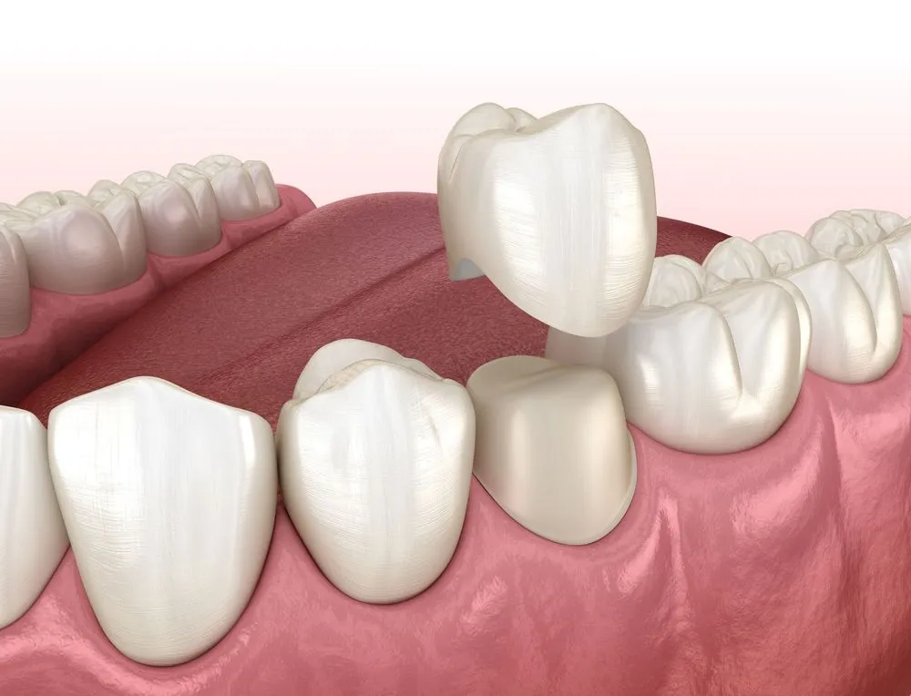 Dental Crown in Hartford CT