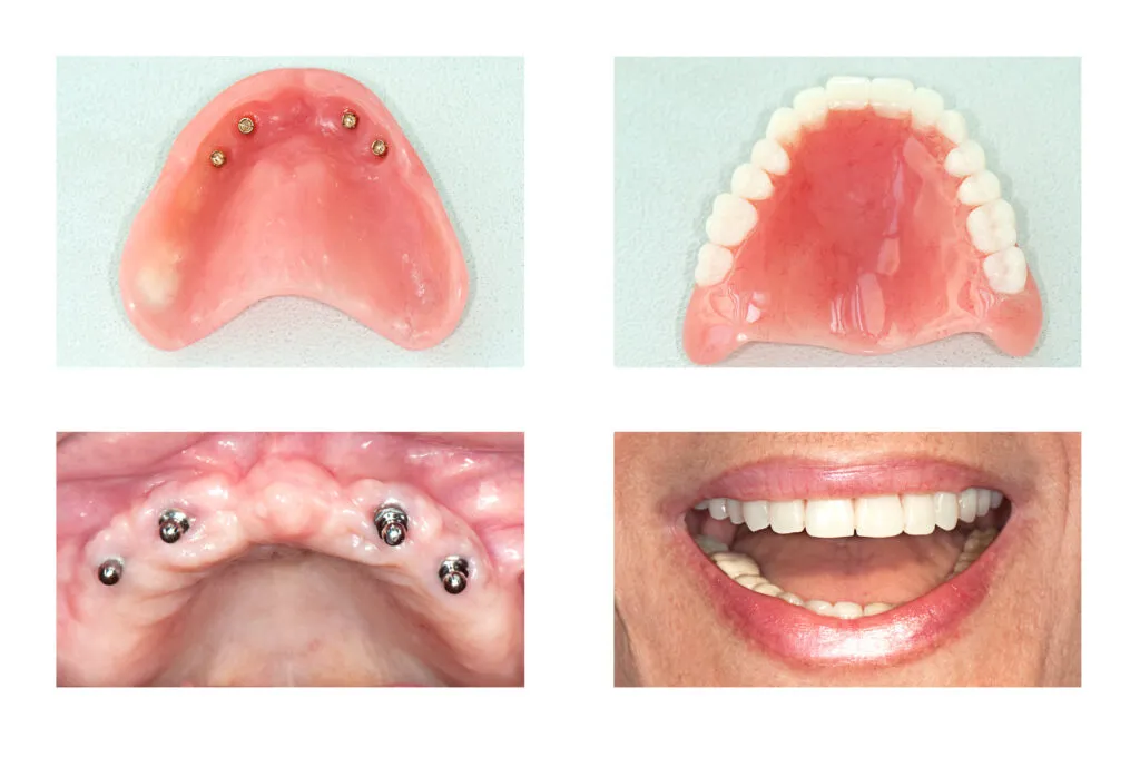 Dental Implants retained complete denture