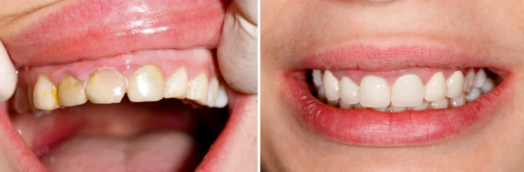 Dental veneers Before and after picture