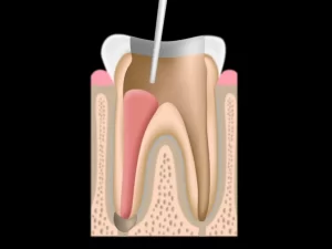 Root Canal Filling