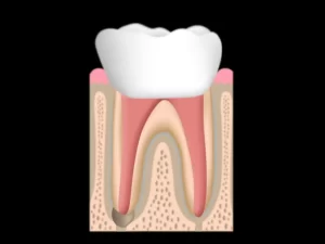 Crown over root canal treatment