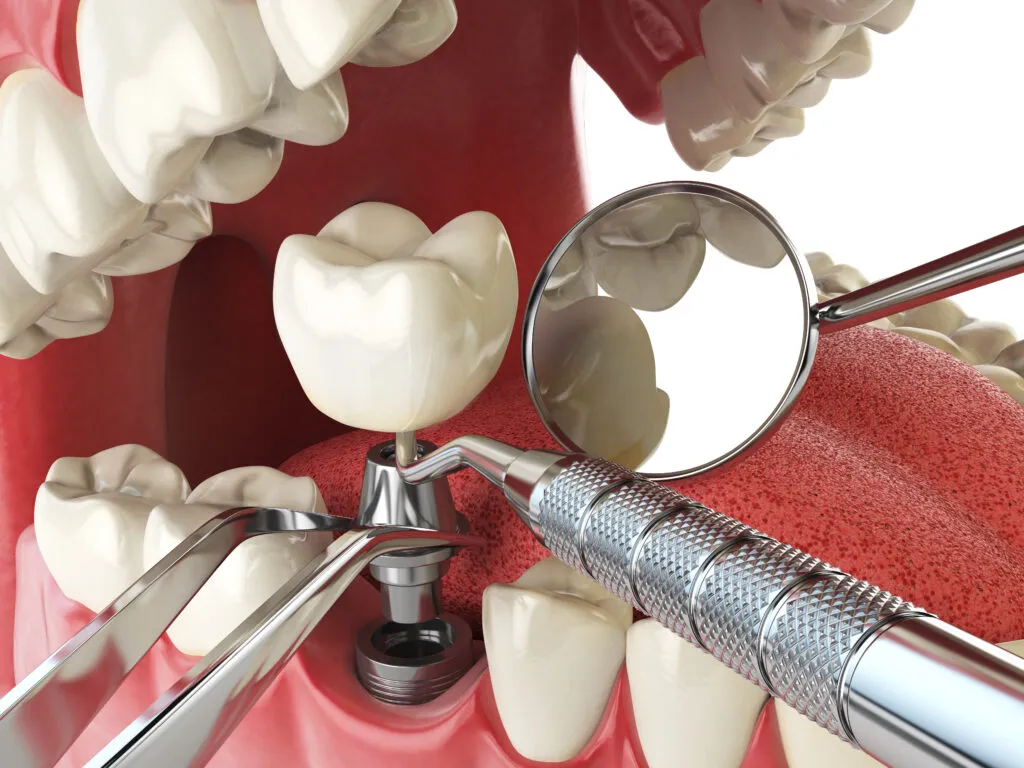 Oral Hygiene after getting Dental Implants