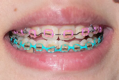 Dental Braces Placement