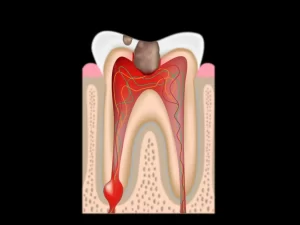 Infected tooth