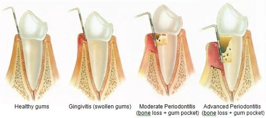 What is Gingivitis?