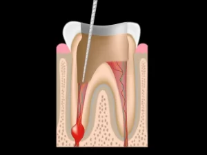 Root canal Cleaning