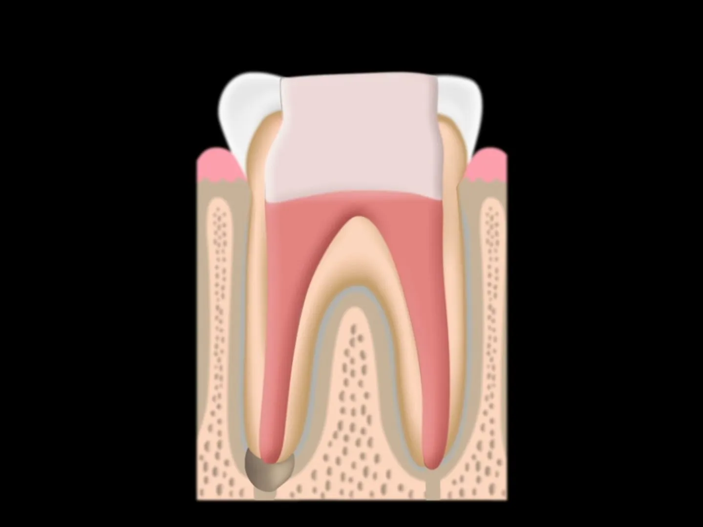 Root Canal Treatment Completed