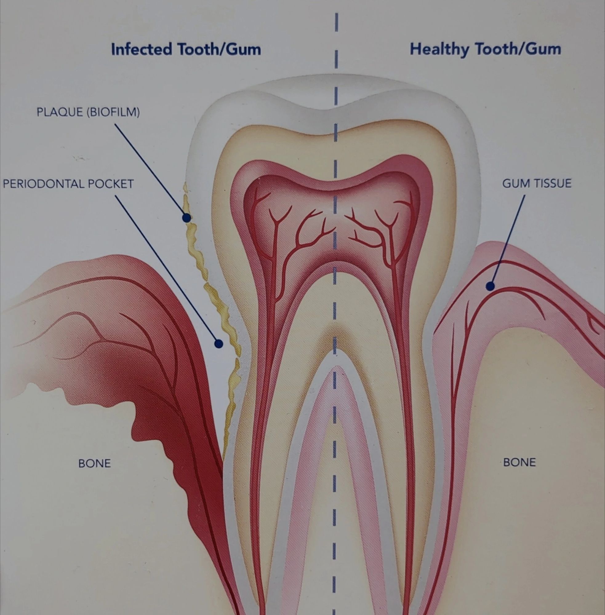 Gingivitis Periodontitis Hartford CT