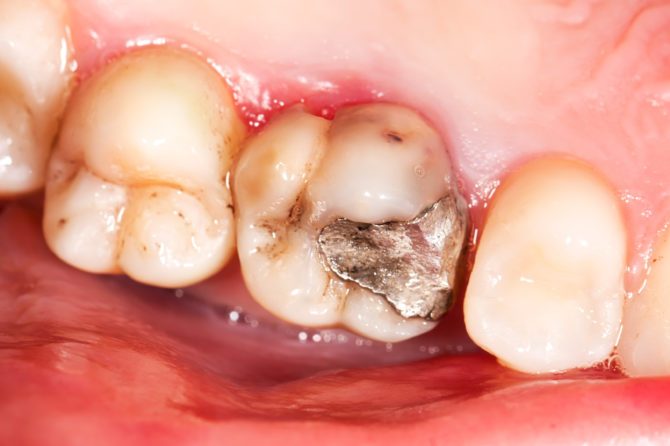 Tooth Pain Dental Fillings Silver amalgam Silver fillings Dental fillings