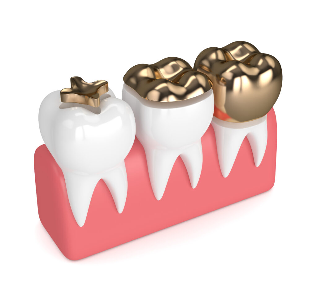  Onlays Inlays Dental Crowns