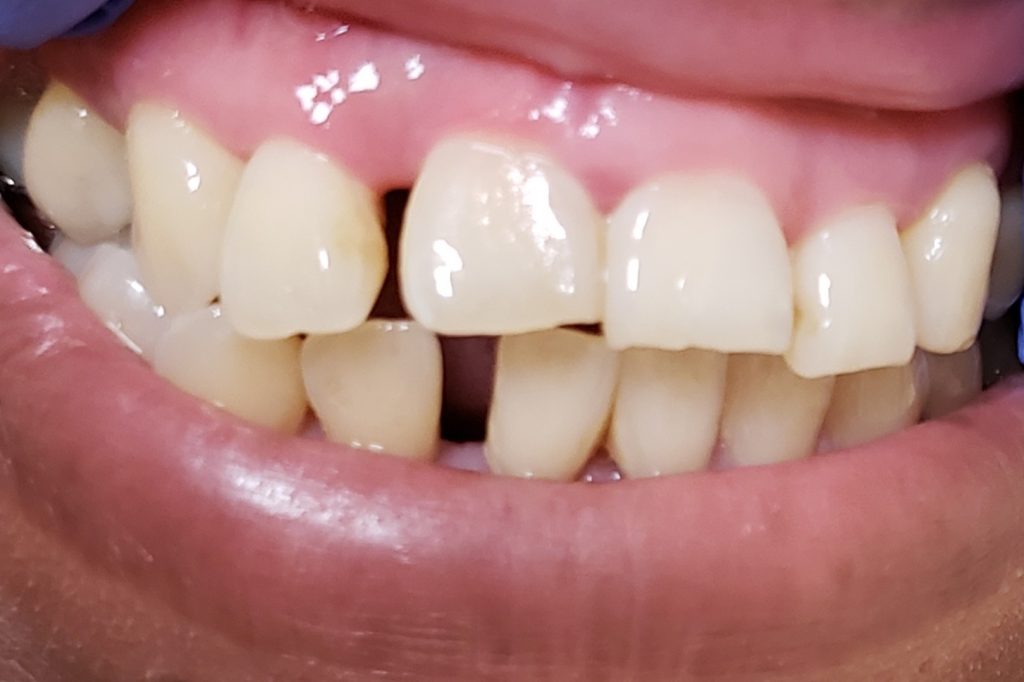 Spacing between teeth infected teeth