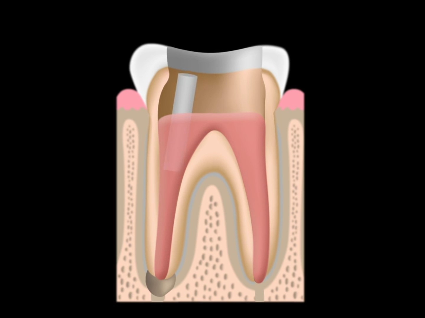root canal treatment post placement dental crown