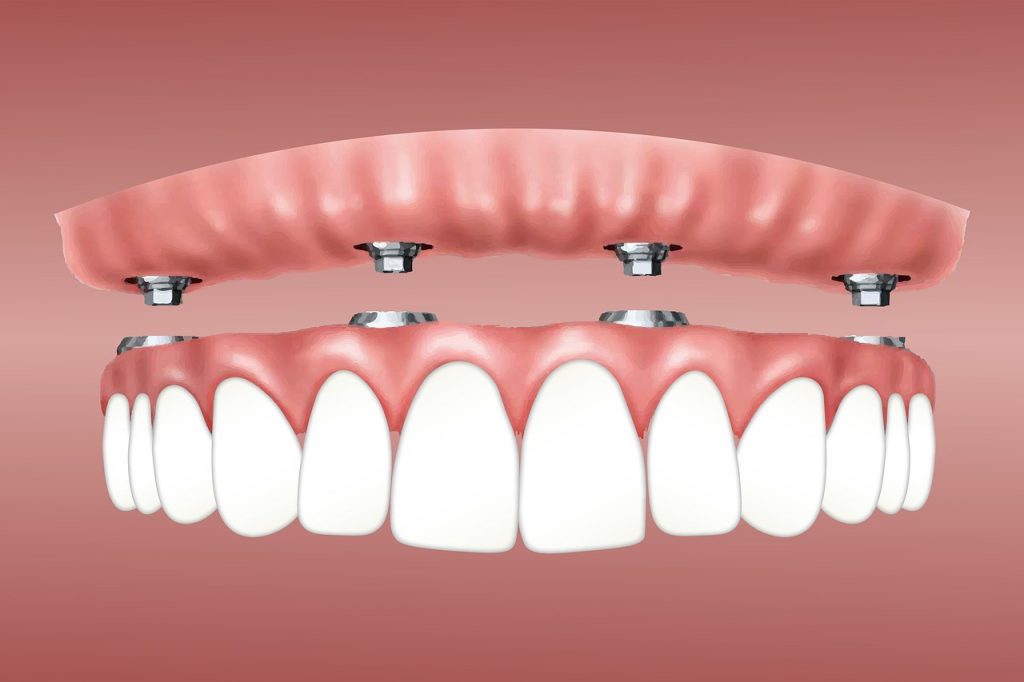 Implant retained over denture Healthy Smiles Hartford