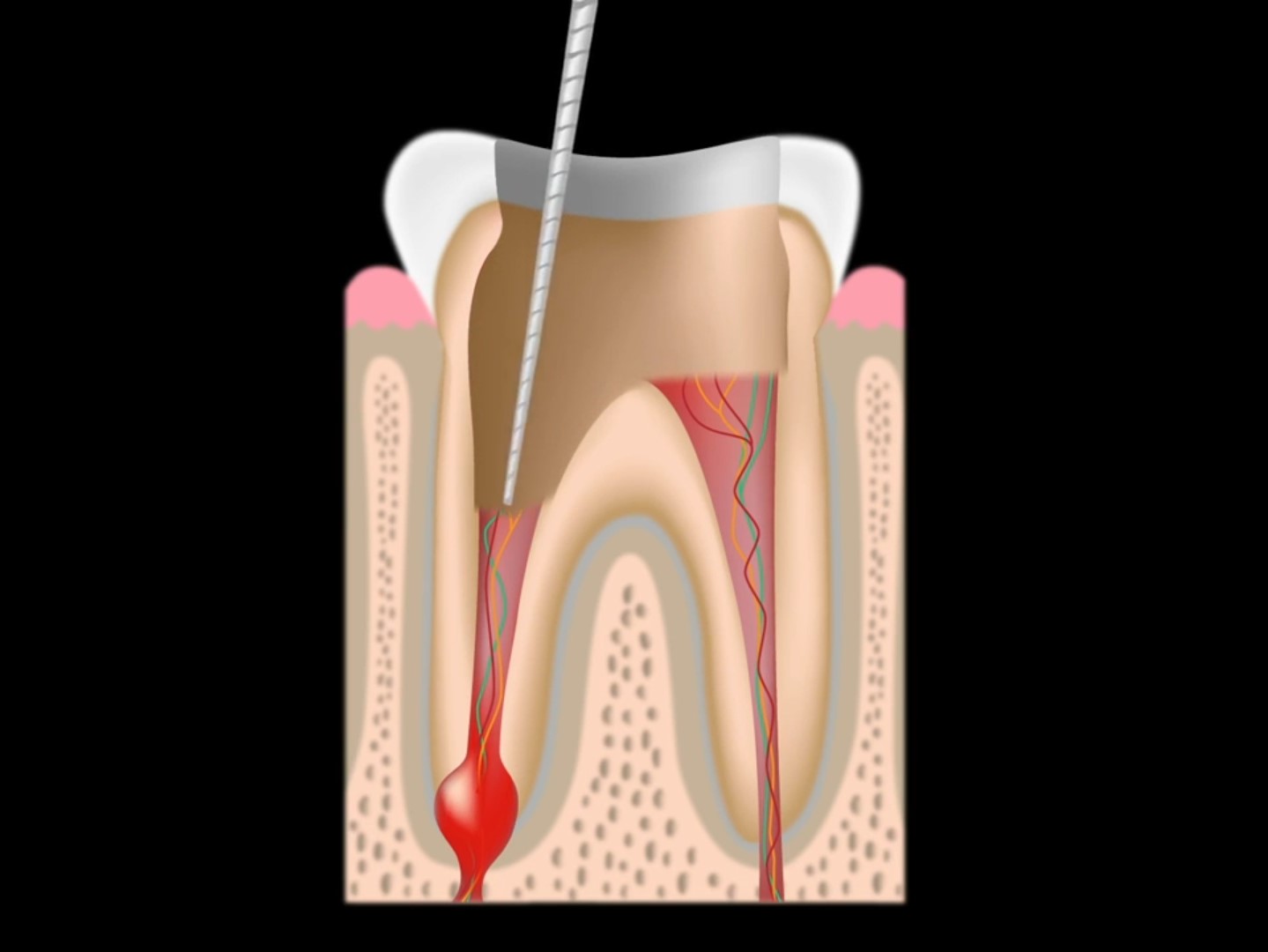 root canal cleaning