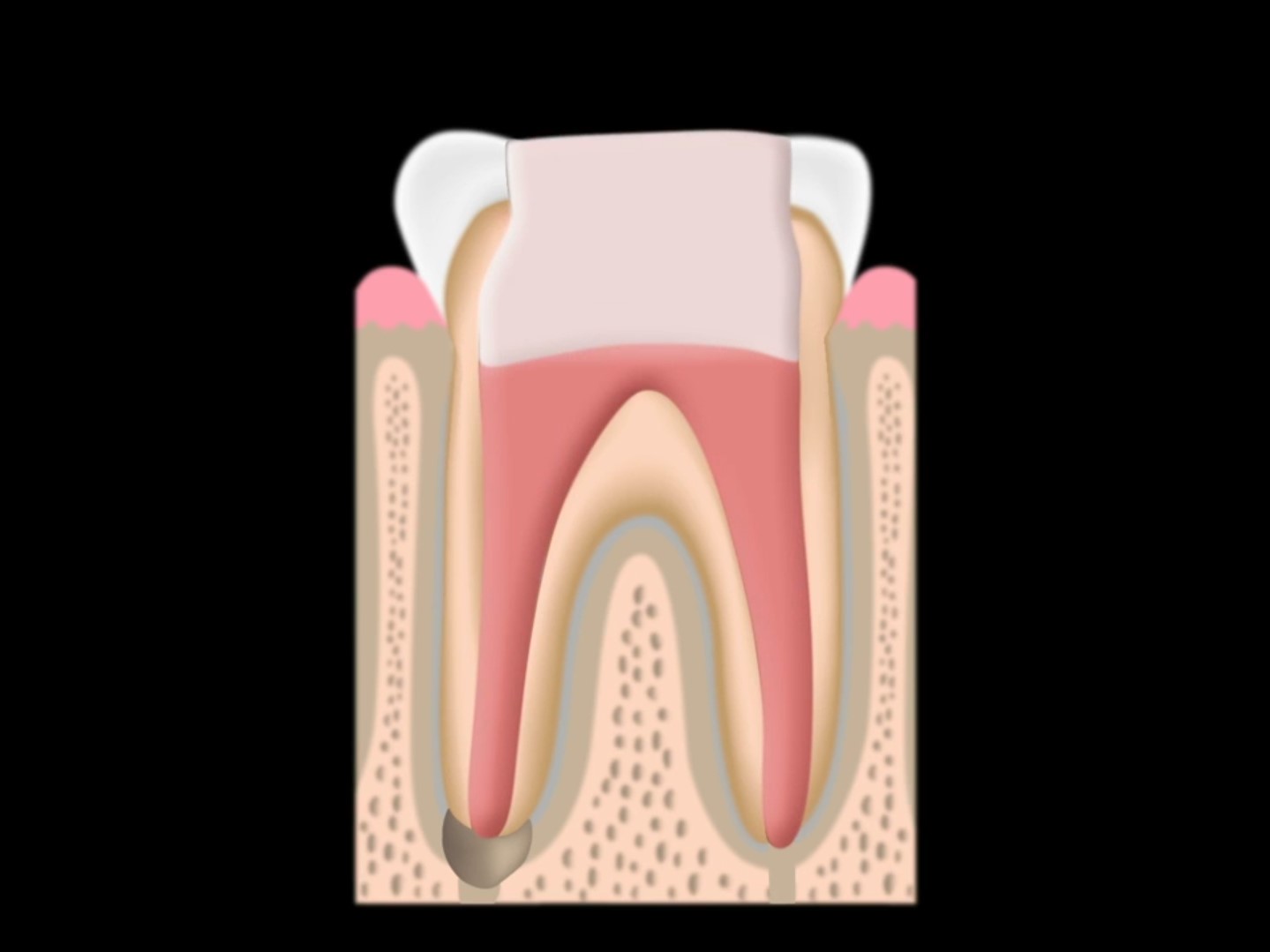 root canal filling dental crown build up