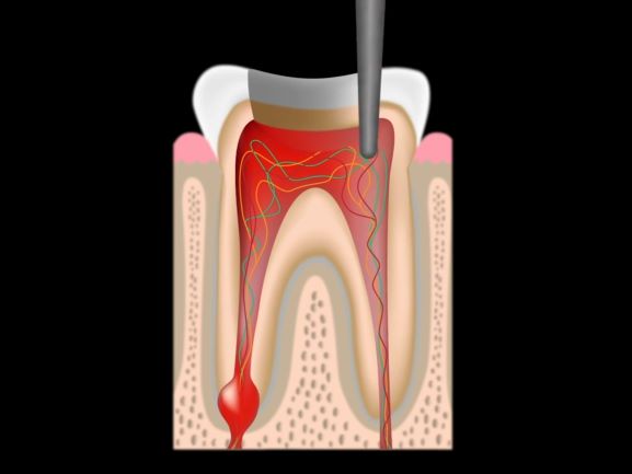 root canal preparation